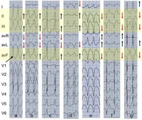室速与室上速的快速鉴别方法
