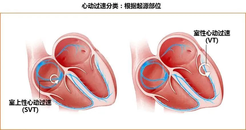 室速与室上速的快速鉴别方法