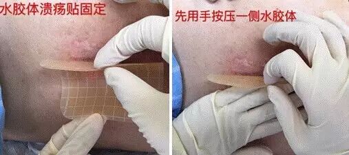 压疮伤口换药，一篇get要点，有图有真相！
