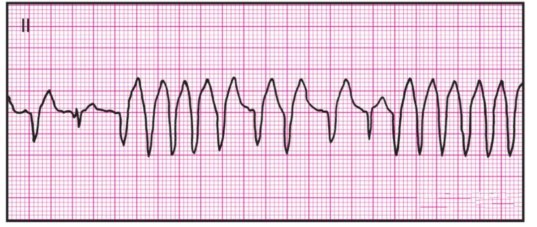 心电监护怎么看图14种异常心电图波形特点，收藏！_https://www.jmylbn.com_新闻资讯_第5张