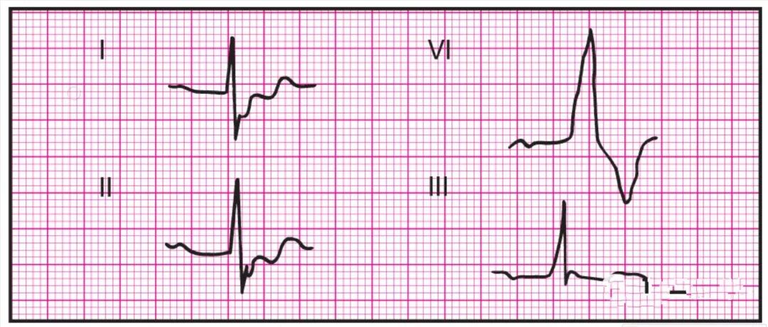 心电监护怎么看图14种异常心电图波形特点，收藏！_https://www.jmylbn.com_新闻资讯_第16张
