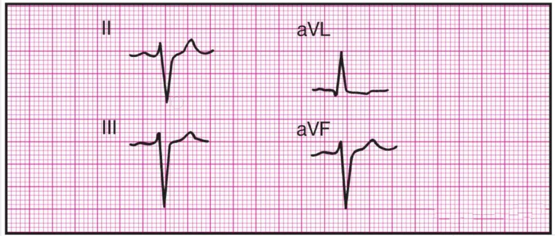心电监护怎么看图14种异常心电图波形特点，收藏！_https://www.jmylbn.com_新闻资讯_第14张