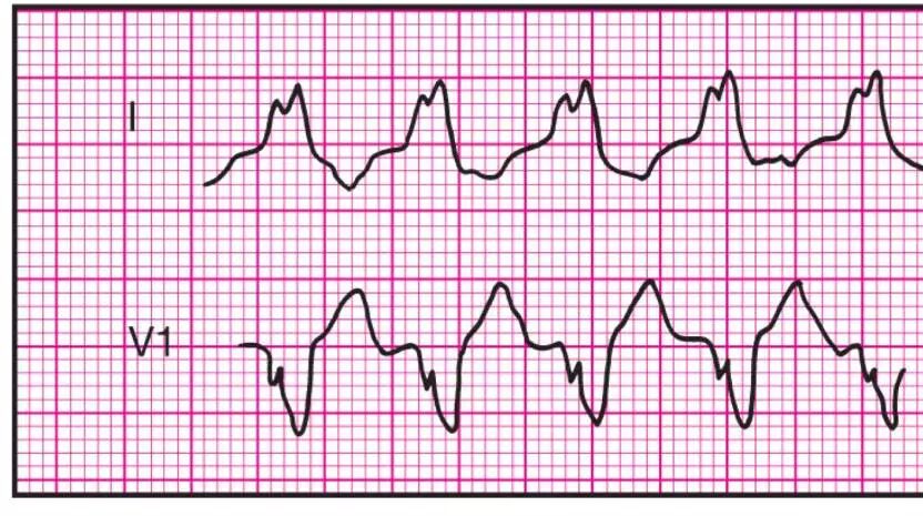 心电监护怎么看图14种异常心电图波形特点，收藏！_https://www.jmylbn.com_新闻资讯_第6张
