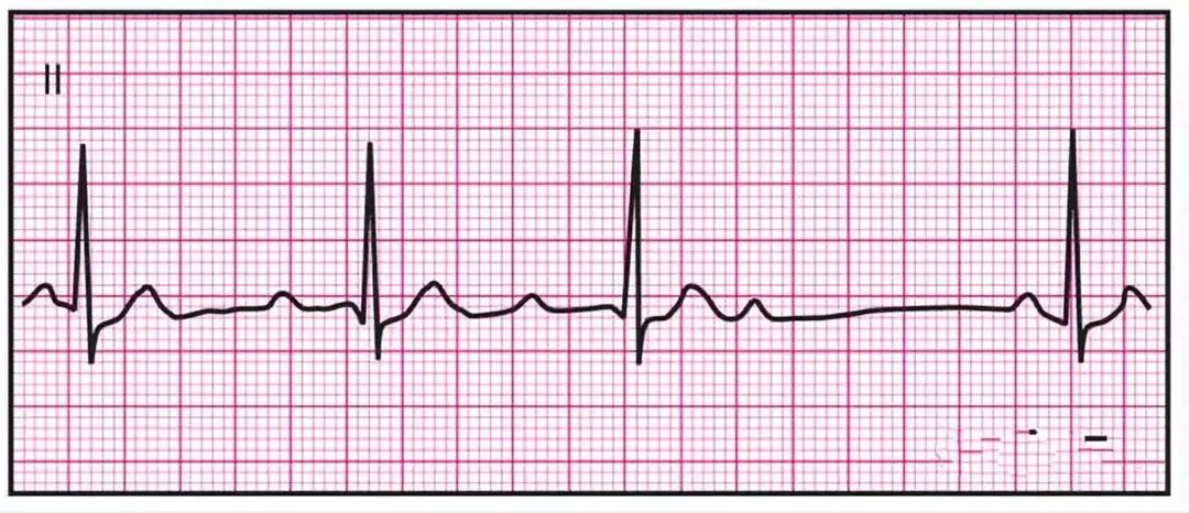 心电监护怎么看图14种异常心电图波形特点，收藏！_https://www.jmylbn.com_新闻资讯_第10张