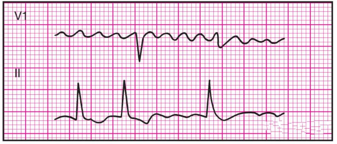 心电监护怎么看图14种异常心电图波形特点，收藏！_https://www.jmylbn.com_新闻资讯_第3张