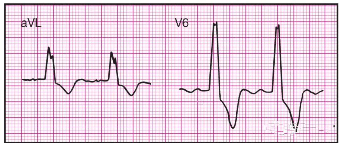 心电监护怎么看图14种异常心电图波形特点，收藏！_https://www.jmylbn.com_新闻资讯_第13张
