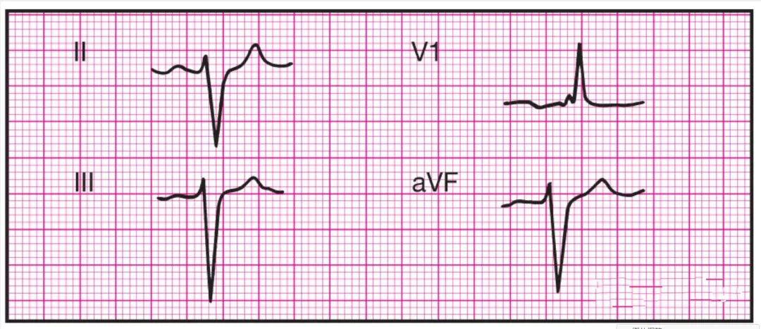 心电监护怎么看图14种异常心电图波形特点，收藏！_https://www.jmylbn.com_新闻资讯_第15张
