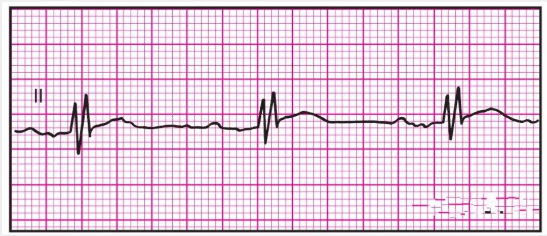 心电监护怎么看图14种异常心电图波形特点，收藏！_https://www.jmylbn.com_新闻资讯_第9张
