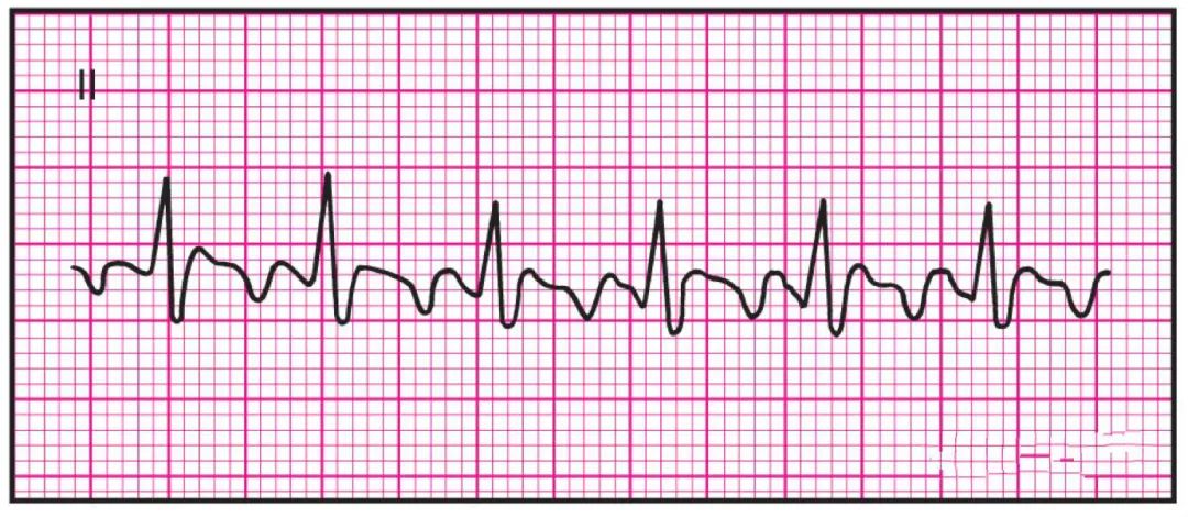 心电监护怎么看图14种异常心电图波形特点，收藏！_https://www.jmylbn.com_新闻资讯_第4张
