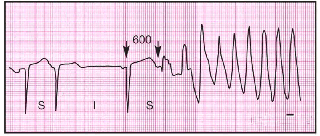 心电监护怎么看图14种异常心电图波形特点，收藏！_https://www.jmylbn.com_新闻资讯_第8张