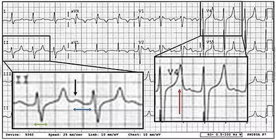 六種可能致命的異常心電圖特征！ 健康 第2張