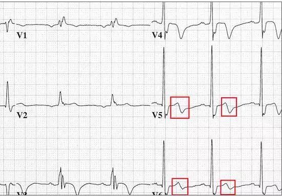 六種可能致命的異常心電圖特征！ 健康 第6張