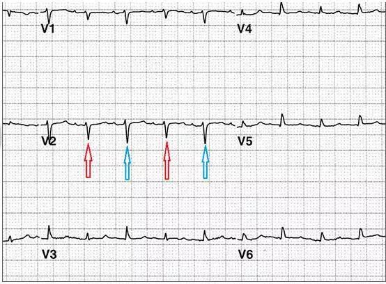 六種可能致命的異常心電圖特征！ 健康 第7張