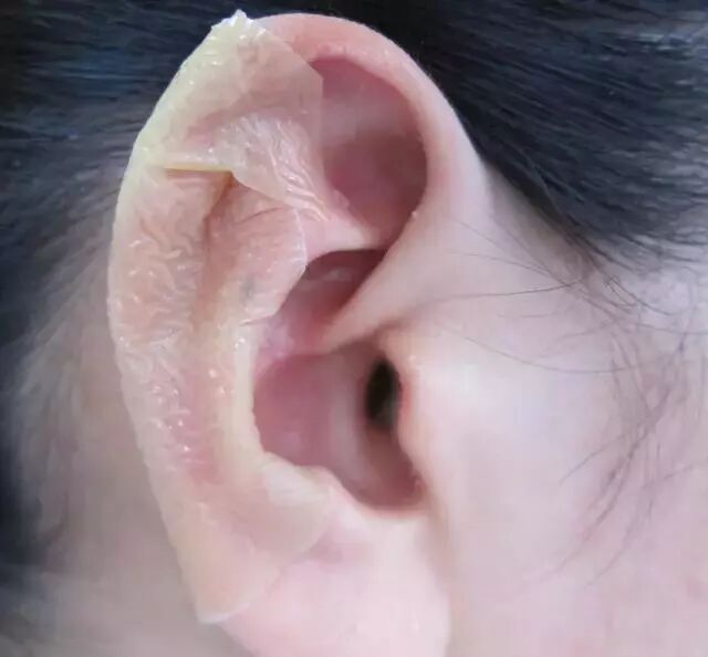 伤口贴敷料为什么特殊部位的敷料粘贴法，护士患者都该学学！_https://www.jmylbn.com_新闻资讯_第2张