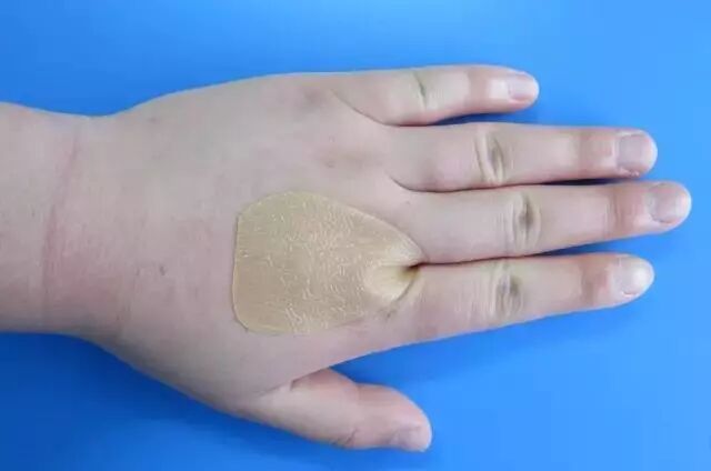 伤口贴敷料为什么特殊部位的敷料粘贴法，护士患者都该学学！_https://www.jmylbn.com_新闻资讯_第12张