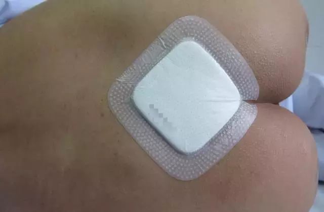伤口贴敷料为什么特殊部位的敷料粘贴法，护士患者都该学学！_https://www.jmylbn.com_新闻资讯_第16张