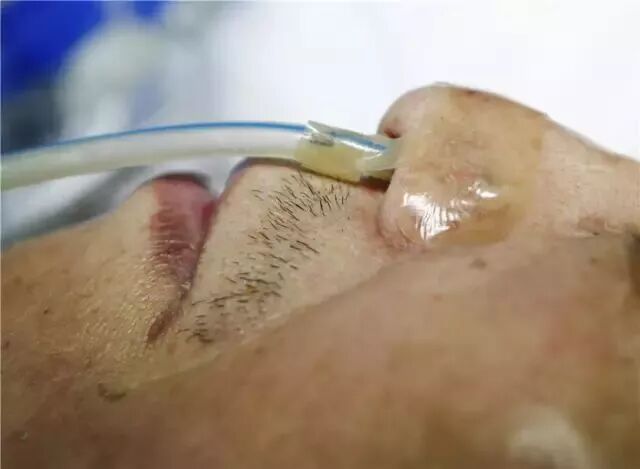 留置胃管鼻贴怎么贴留置胃管鼻贴到底怎么贴，老年人最舒服？有对比有真相！_https://www.jmylbn.com_新闻资讯_第9张