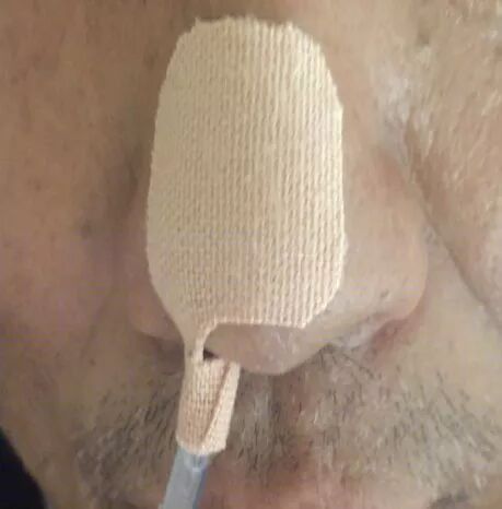 留置胃管鼻贴怎么贴留置胃管鼻贴到底怎么贴，老年人最舒服？有对比有真相！_https://www.jmylbn.com_新闻资讯_第8张