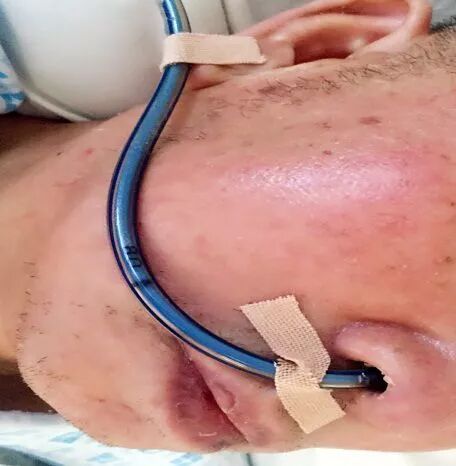 留置胃管鼻贴怎么贴留置胃管鼻贴到底怎么贴，老年人最舒服？有对比有真相！_https://www.jmylbn.com_新闻资讯_第2张