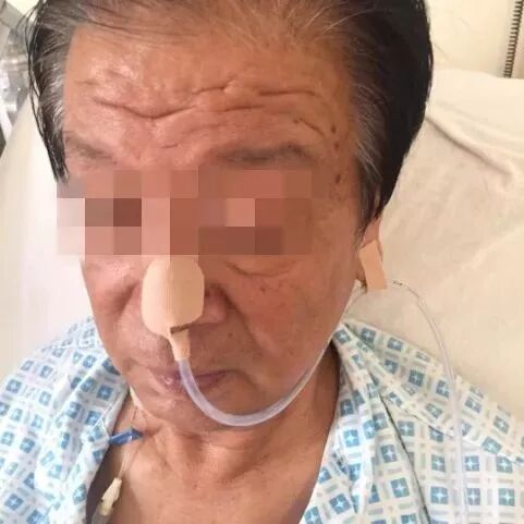 留置胃管鼻贴怎么贴留置胃管鼻贴到底怎么贴，老年人最舒服？有对比有真相！_https://www.jmylbn.com_新闻资讯_第10张