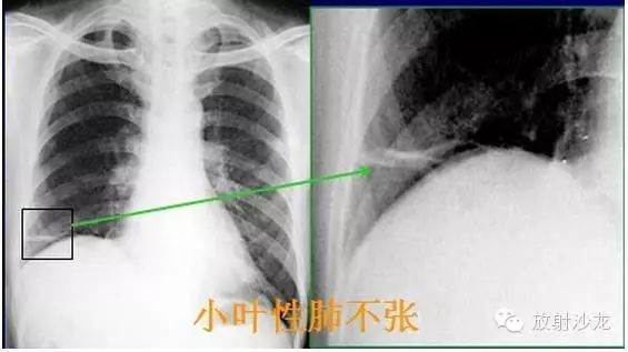 肺部x線病變的7種常見徵象 建議收藏 華醫網 微文庫