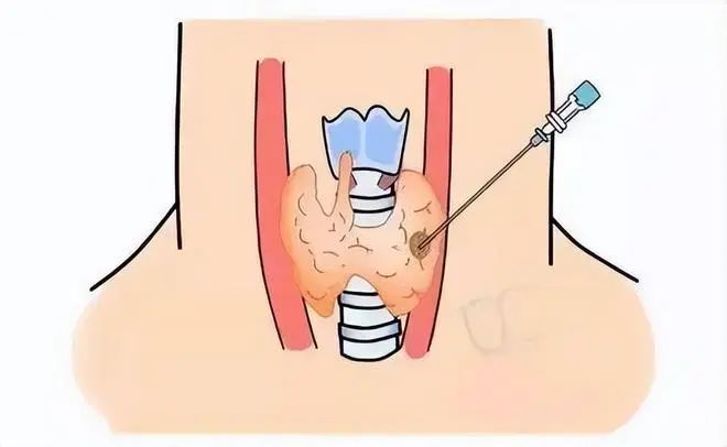 為什麼檢查出甲狀腺結節後醫生建議進行穿刺活檢