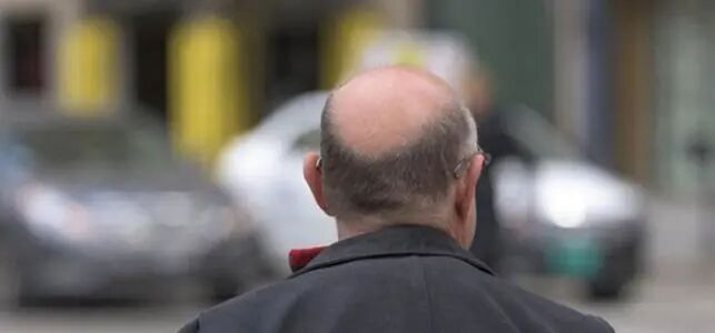 脂溢性脱发和脂溢性皮炎有什么关系？