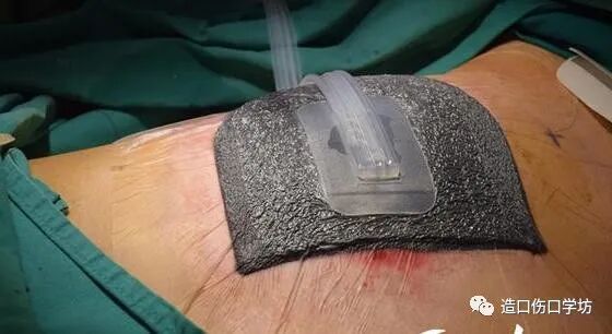 vsd敷料怎么去VSD负压治疗护理要点_https://www.jmylbn.com_新闻资讯_第7张