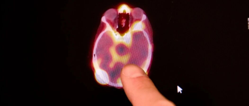 MRI和超声波可以将抗癌药物送入大脑