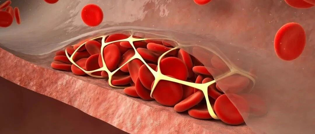 血小板增高原因众多，这些症状你了解吗？