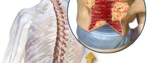 【血液科】发病率超过白血病，误诊率高达70%——这个疾病你了解吗？