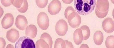 为什么会得过敏性紫癜？与这些因素有关