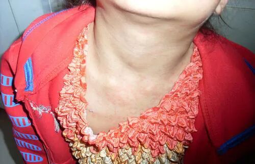 白血病严重会淋巴结肿大!除治疗外,多吃这些快速消除!-友友