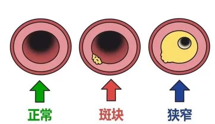 颈动脉斑块图片及说明图片