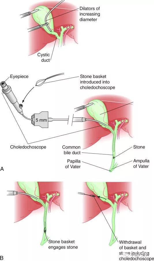 十二指肠镜胆总管取石 腹腔镜下胆囊切除(ercp lc)腹腔镜,十二指肠镜
