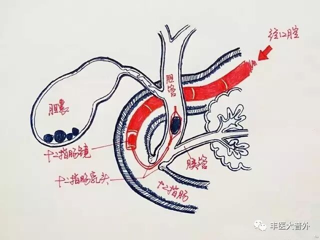 若术中lc 或est 失败,可以立即中转开腹手术,使患者免于再次手术的