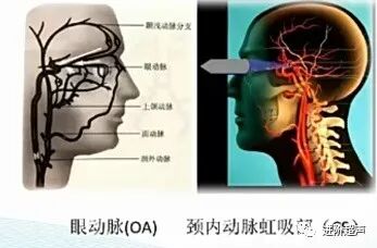 彩色经颅多普勒是什么周围血管｜经颅彩色多普勒超声TCCD_https://www.jmylbn.com_新闻资讯_第17张
