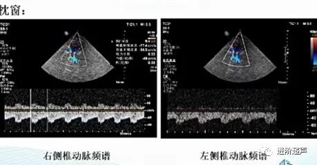 彩色经颅多普勒是什么周围血管｜经颅彩色多普勒超声TCCD_https://www.jmylbn.com_新闻资讯_第16张