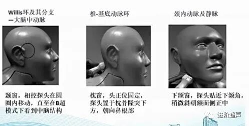 彩色经颅多普勒是什么周围血管｜经颅彩色多普勒超声TCCD_https://www.jmylbn.com_新闻资讯_第10张