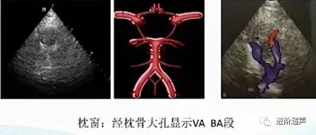 彩色经颅多普勒是什么周围血管｜经颅彩色多普勒超声TCCD_https://www.jmylbn.com_新闻资讯_第15张