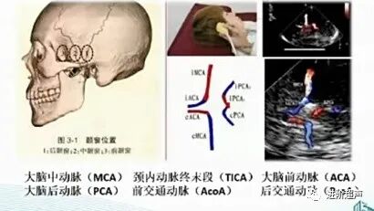 彩色经颅多普勒是什么周围血管｜经颅彩色多普勒超声TCCD_https://www.jmylbn.com_新闻资讯_第12张