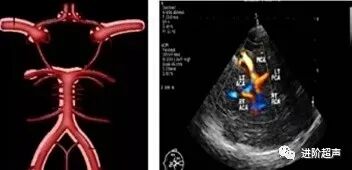彩色经颅多普勒是什么周围血管｜经颅彩色多普勒超声TCCD_https://www.jmylbn.com_新闻资讯_第13张