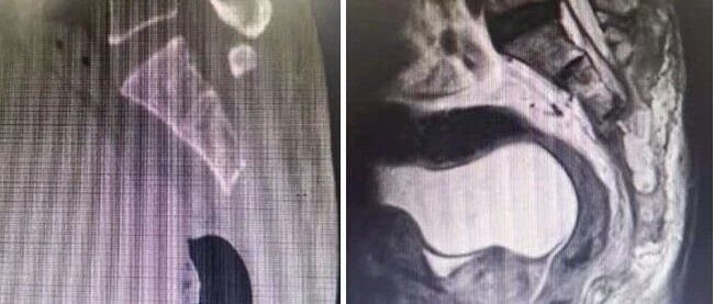 靠着3D打印 巨大骶骨脊索瘤被成功切除