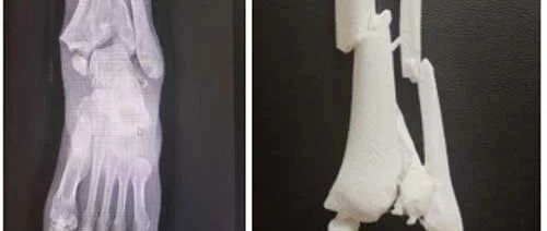 延安市中医医院借力3D打印技术 助推骨科创伤直观复原