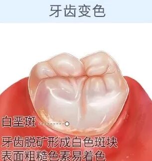 怎么选洁牙器械洗牙到底有好处还是坏处？牙医告诉你真相_https://www.jmylbn.com_新闻资讯_第4张