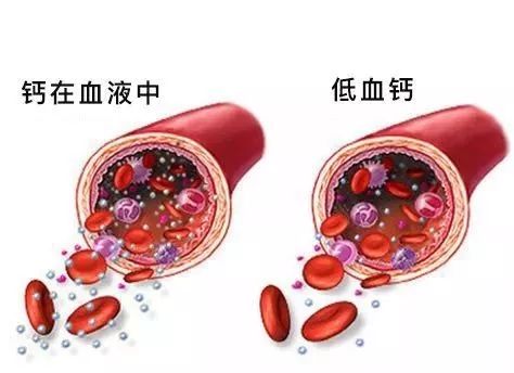 据介绍，低钙血症是血钙低于正常值的现象，属于钙代谢紊乱。由于钙发挥