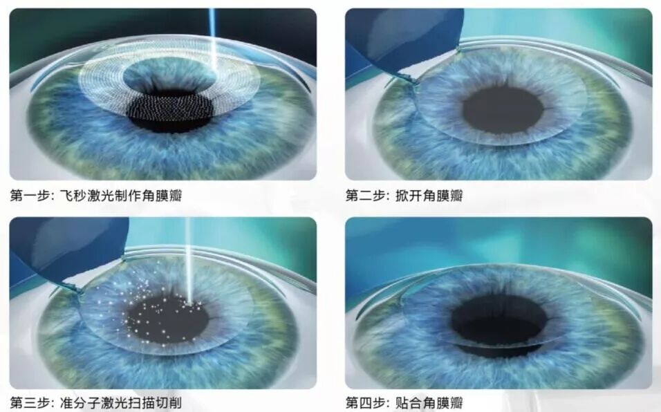 涿州立明眼科医院