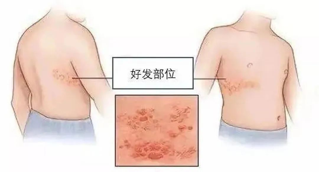 带状疱疹及其防治