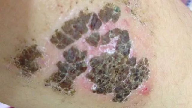 痂皮真的能保护伤口吗? 痂皮真的能保护伤口吗?