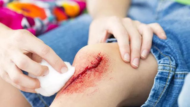 痂皮真的能保护伤口吗? 痂皮真的能保护伤口吗?